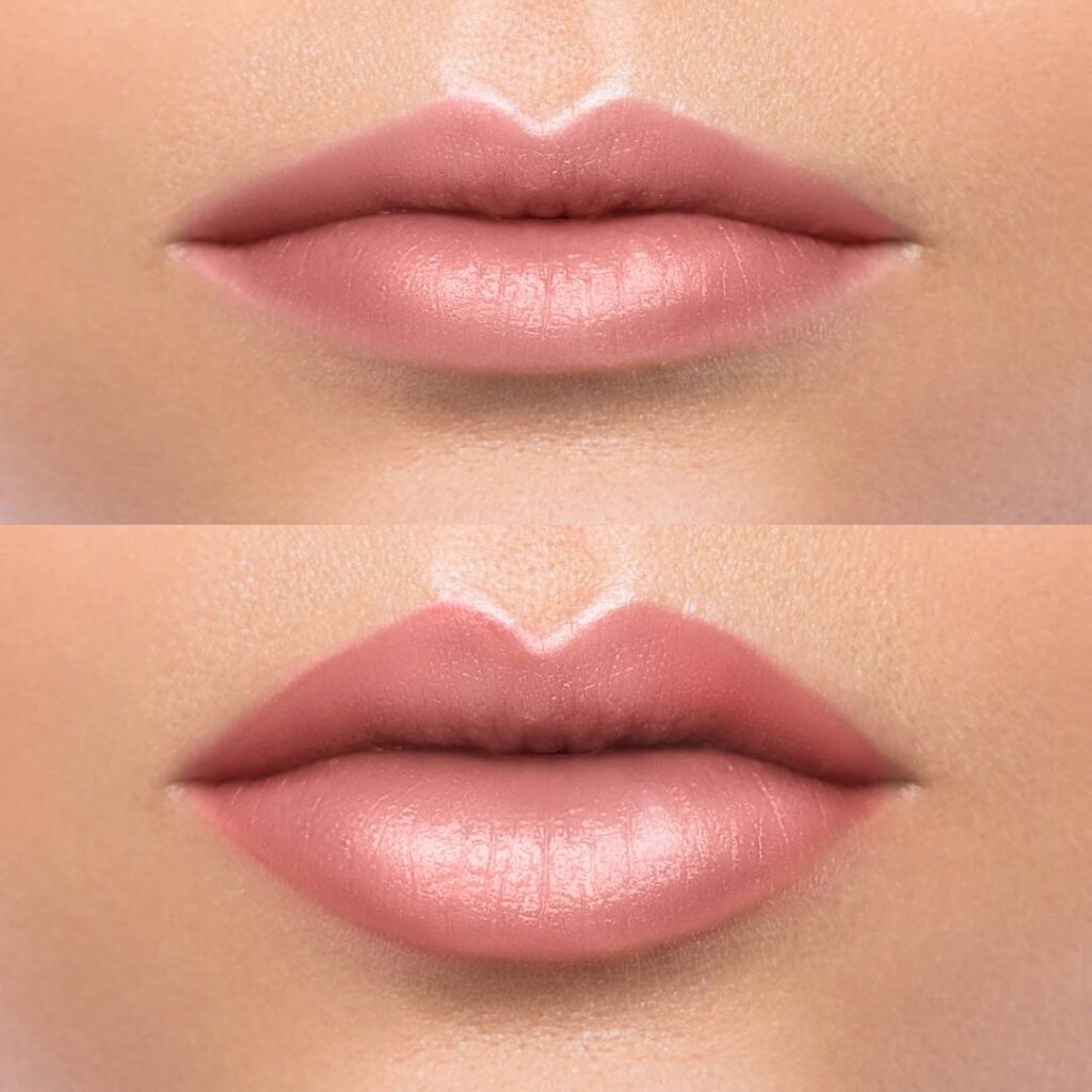 Lippenunterspritzung