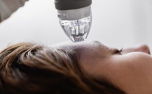 Radiofrequenz und Microneedling