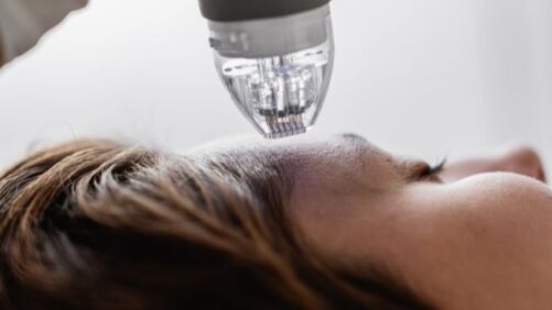 Radiofrequenz und Microneedling